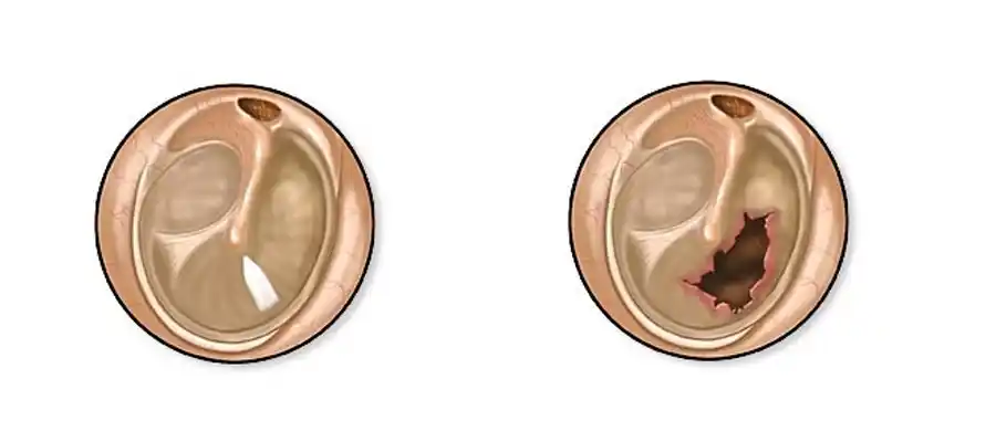 Timpanoplast