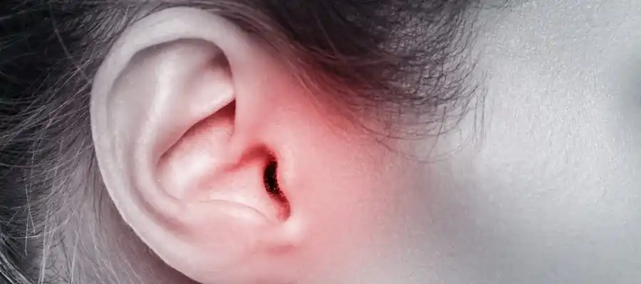 middle-ear-infections-acute