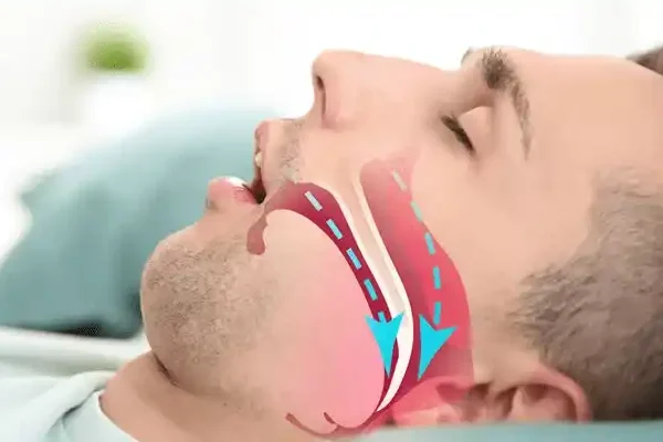 horlama-ve-uiyku-apnesi