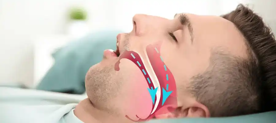 horlama-ve-uiyku-apnesi