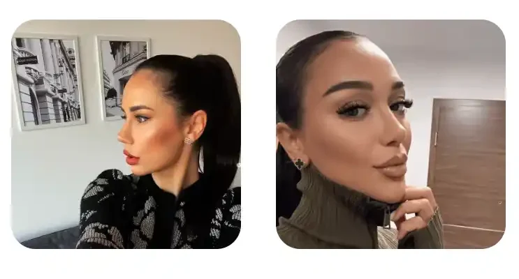 Burun Estetiği Fiyatları